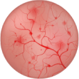 Bladder with cystitis